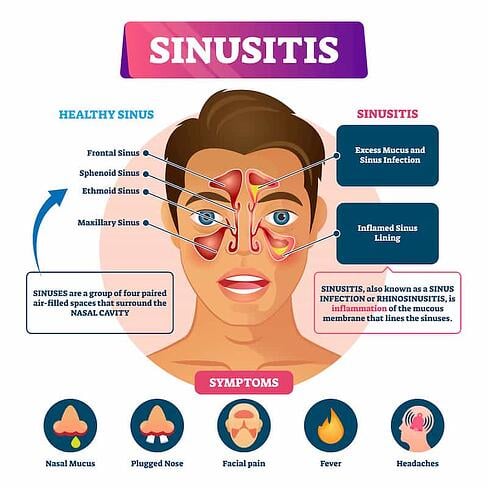 symptômes de sinusite-1